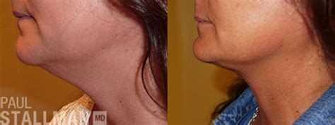 Facial Liposuction Before And After Photo Gallery Fresno Santa Maria
