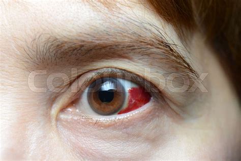 Woman With Burst Blood Vessel In Eye Stock Image Colourbox