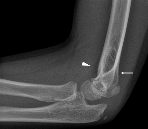 Elbow Effusion Utility And Limitations Of Radiography In Pediatric