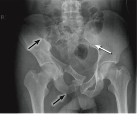 Pelvic Fractures A Guide To Treatment Within A Trauma Unit Rcemlearning