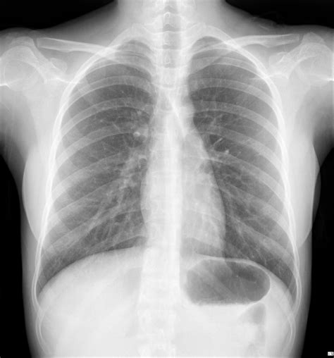 Chest X Ray Interpretation In Patients With Fever Cough Colds Radiology Imaging
