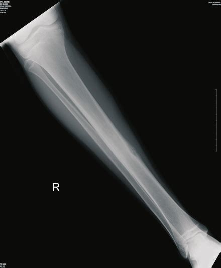Radiograph Of Right Tibia Showing Diaphyseal Cortical Lesion With