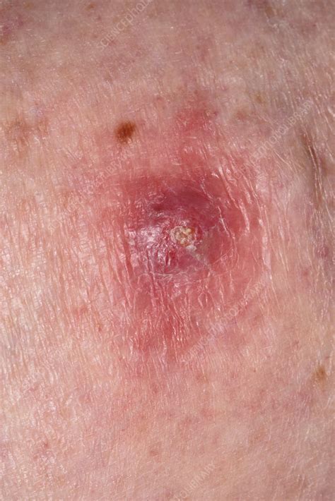 Skin Cancer On The Leg Stock Image C051 1230 Science Photo Library