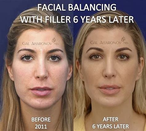Temple And Forhead Filler Plastic Surgery