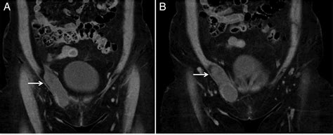 A Cautionary Approach To Adult Female Groin Swelling Hydrocoele Of The
