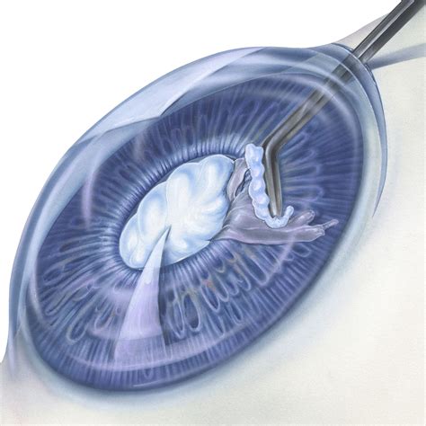History Of Cataract Surgery Chicago Il Removal Treatment Evolution