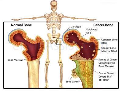 Bone marrow is the spongy tissue found inside the inner part of some of our large bones. Bone metastasis - Doctor