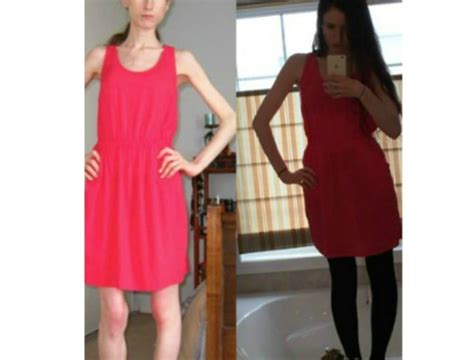 The 23yo Who Posted Her Anorexia Recovery Photos Online