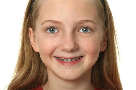 Braces For Kids Costs And Different Types Offered In The Uk