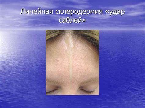 Диета при склеродермии системной Коллагенозы: красная волчанка, склеродермия - online presentation Коллагенозы: красная волчанка, склеродермия - online presentation Диета при склеродермии системной
