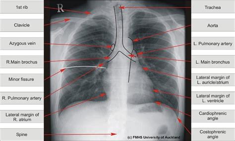 Labeled chest radiographs teaching radiologic anatomy with a level of detail appropriate for medical students. labeled chest x ray - Google Search (With images ...