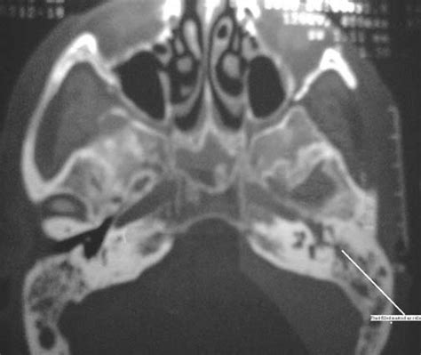 Axial Cut Of Hrct Temporal Bone Showing Left Mastoiditis And Sphenoid