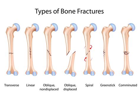 Bone Fractures During Pregnancy And Breastfeeding The Pulse