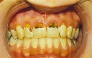 tooth decay   major oral health problem   people tooth