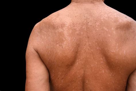 What Causes An An What You Need To Know About Tinea Versicolor