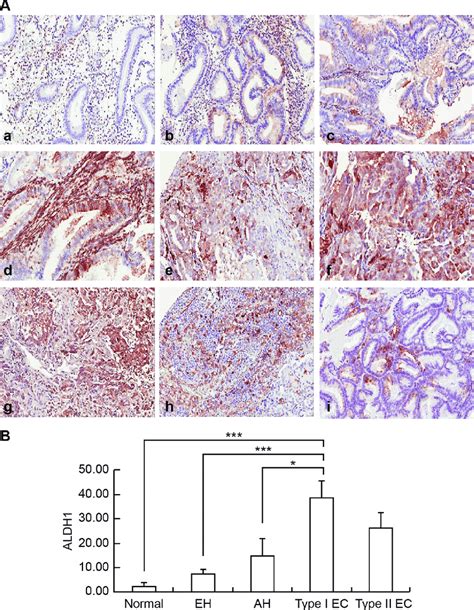 Examples of immunohistochemical staining for ALDH1 in endometrial 