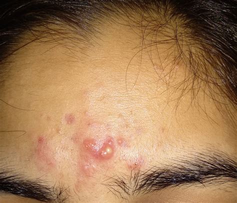 Inflammatory Acne On Forehead General Acne Discussion