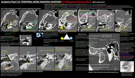 Temporal Bone Imaging Anatomy Facial Nerve By Dr GrepMed