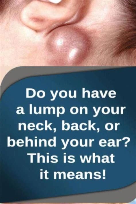 Do You Will Have A Lump On Your Neck Back Or Behind Your Ear This