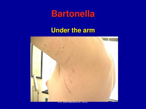 Ppt Case Histories Bartonella Like Organisms Powerpoint Presentation