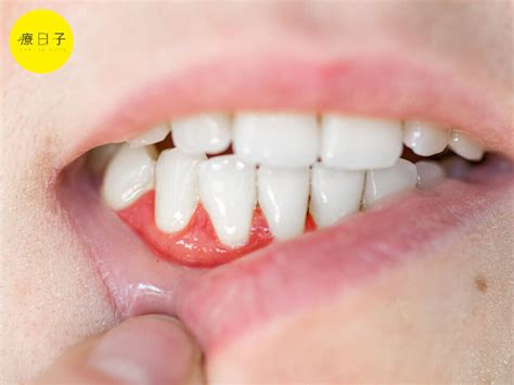 牙齦萎縮、出血，牙周病治療方式有哪些？醫：這樣做避免復發！ 牙醫大叔愛碎念i黃柏青醫師