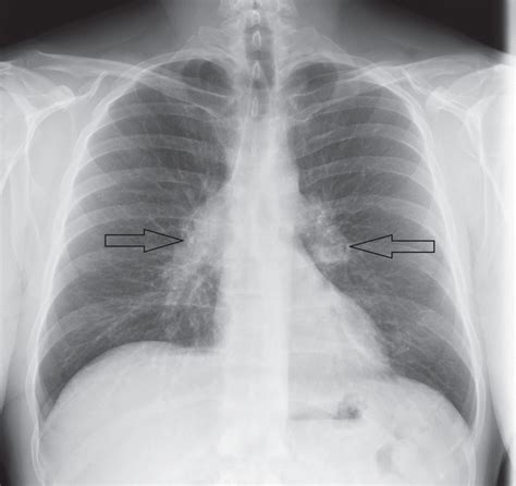 Chest X Ray Showed Bilateral Hilar Lymphadenopathies Arrows Images