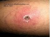 Pictures of Lyme Disease Rash Itch Treatment