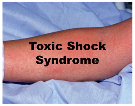 Toxic Shock Syndrome Adalah Homecare24