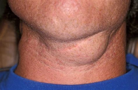 What To Do If The Lymph Nodes On The Neck Are Inflamed And To Whom To