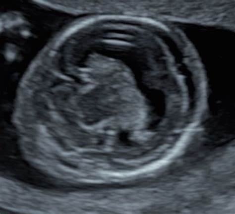 Alobar Holoprosencephaly Prenatal Ultrasound 1st Trimester