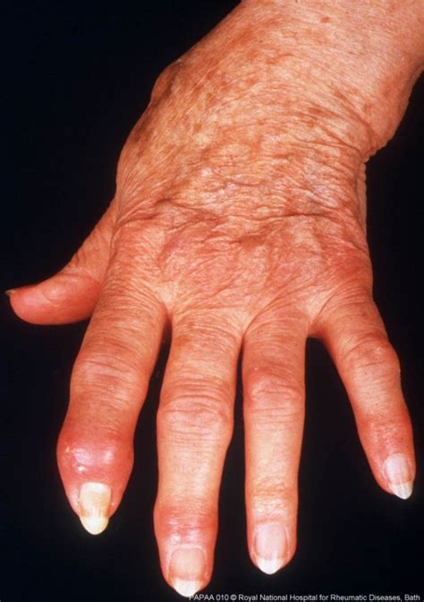 Psoriasis And Psoriatic Arthritis Alliance Papaa