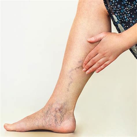 Sclerotherapy Scottsdale Skin And Holistic Health