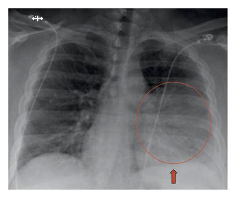 Chest X Ray 2 Views Revealing Left Lower Lobe Pneumonia With Trace Left
