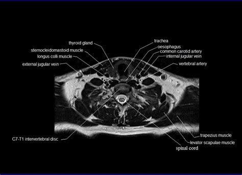 Dimitrios mytilinaios md, phd last reviewed: MRI neck anatomy | free MRI axial neck cross sectional anatomy