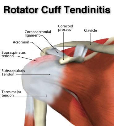 What Is Rotator Cuff Tendinitis Physiotherapy Chiropractic Massage