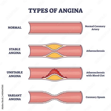 Types Of Angina As Chest Pain And Heart Problem Explanation Outline