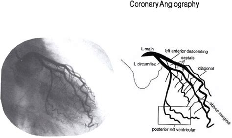 Left Coronary Artery Anatomy And Angiogram Download Scientific Diagram