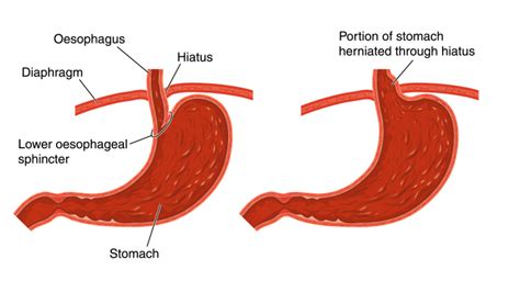 Hiatal Hernia And Normal Anatomy Of The Stomach Stock Illustration