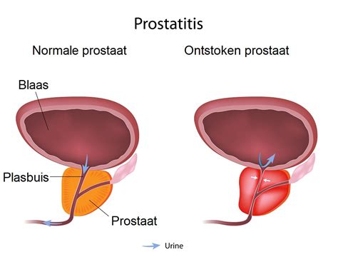 Prostaatontsteking Symptomen Oorzaken En Behandeling Mens Gezondheid