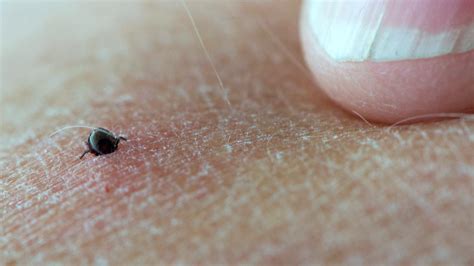 Lyme Disease Know The Symptoms Central Itv News