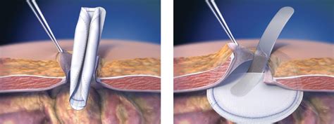 Umbilical Ventral Hernia Laparoscopic Hernia Repair Surgery Dubai