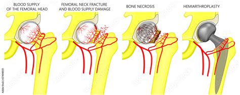 Vector Illustration Of Femoral Head Blood Supply Femoral Neck Fracture The Best Porn Website