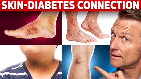 9 Diabetic Skin Problems That Indicate Diabetes Gadico Modern