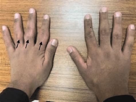 A Photograph Of The Patients Hands Showing Thickening And Swelling Of