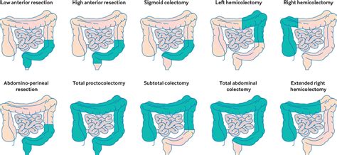 Management Of Colorectal Cancer The Bmj