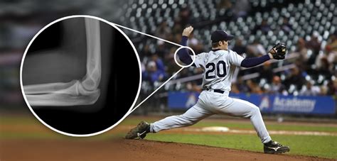 And while the typical return from tommy john surgery takes a year, an unsuccessful rehab may wind up costing a pitcher nearly two seasons, depending on its length and when the injury occurs. Does Tommy John Surgery Affect Pitcher Longevity ...