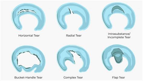 Posterior Horn Medial Meniscus Tear Recovery Time