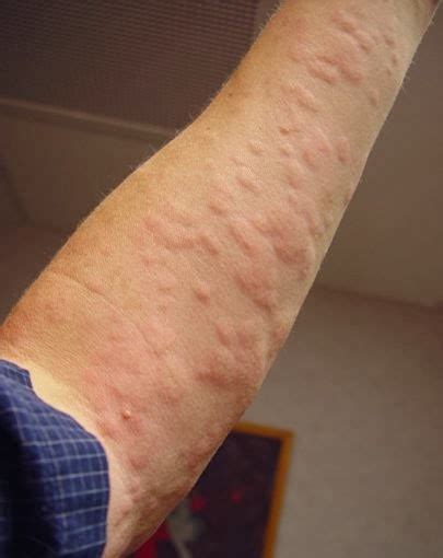 Hives Causes Treatment And Conditions Wiki Itchy Mind