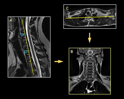 Mri Blog Brachial Plexus Mri Iii