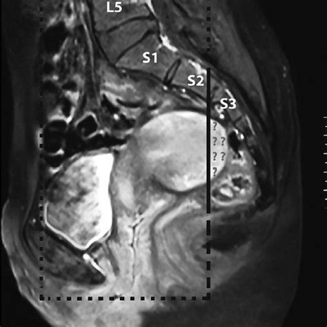 Magnetic Resonance Imaging Showing A Retroverted Uterine Corpus